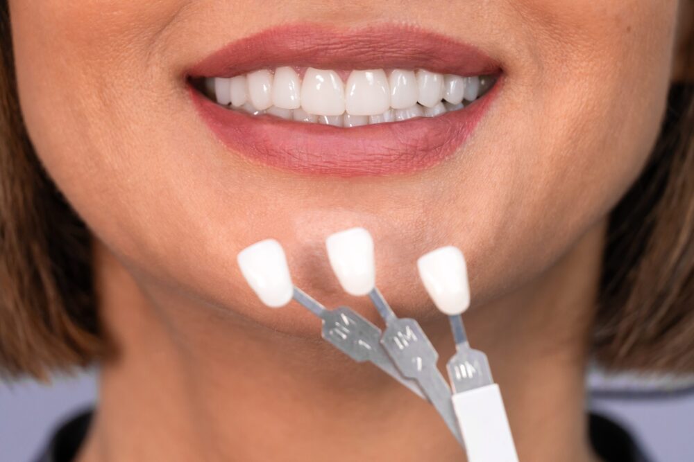 Dental Veneers in Maryville