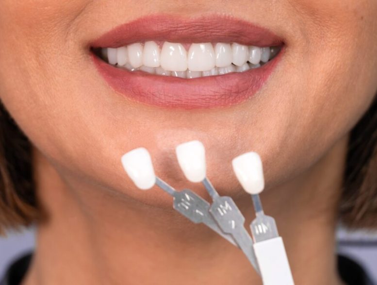 Dental Veneers Maryville
