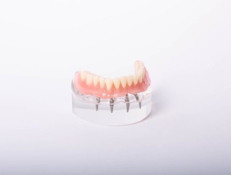 Implant-Supported Dentures Maryville